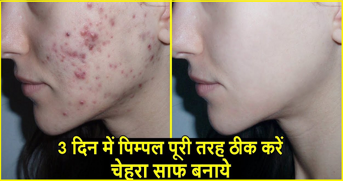get rid of pimples acne naturally