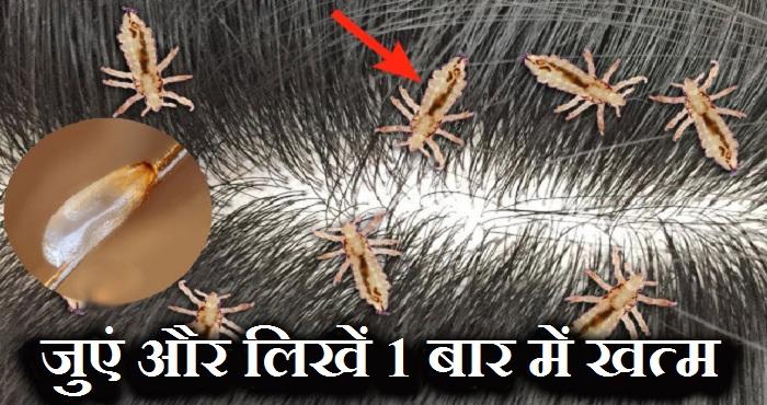 head lice and nits removal home remedy