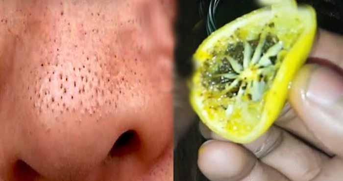 home remedies to remove blackheads and whiteheads