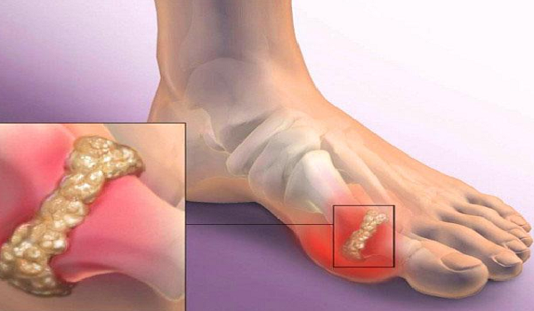joint pain high uric acid problems and cure