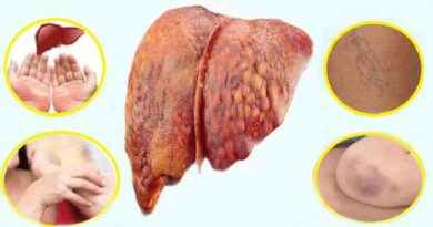 know about 6 early signs of liver damage