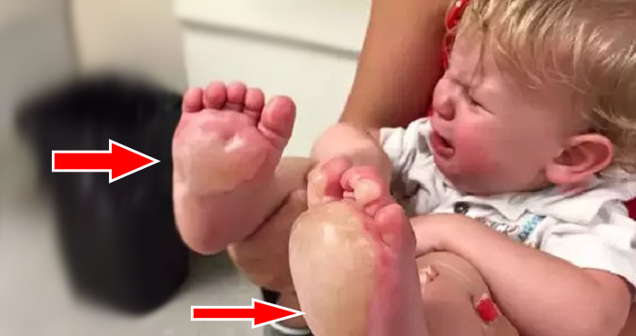 mom sees blisters on baby feet