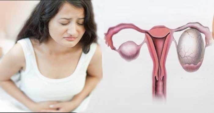 ovarian cysts symptom and solution