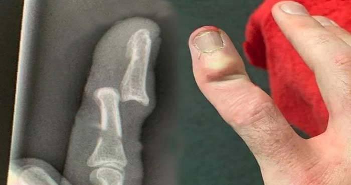 rikki clarke suffers a terrible finger injury