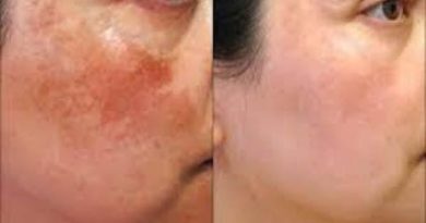 special simple tricks remove dark spots from face